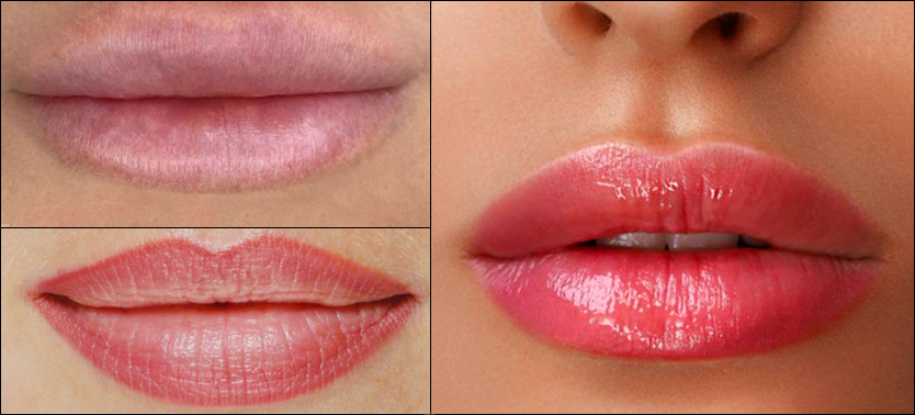 lips before – after